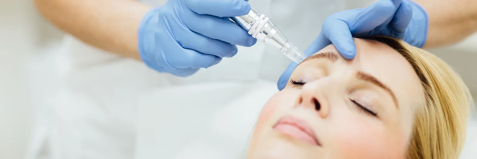 Akne Medical Needling mit SkinPen im Kuzbari Zentrum Wien
